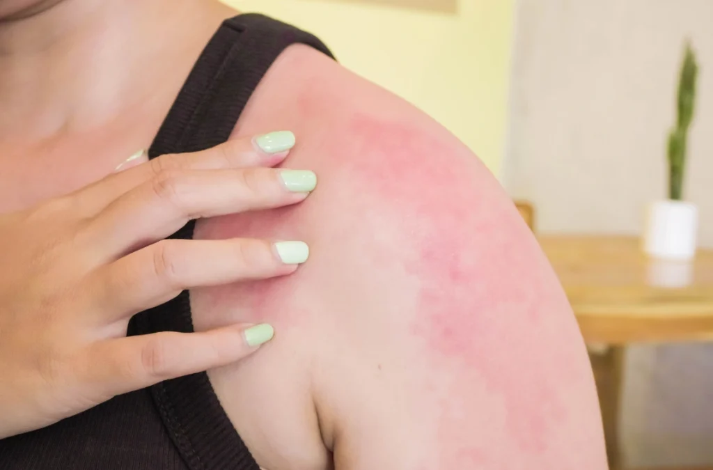 skin concern- Chronic Skin Redness and Irritation