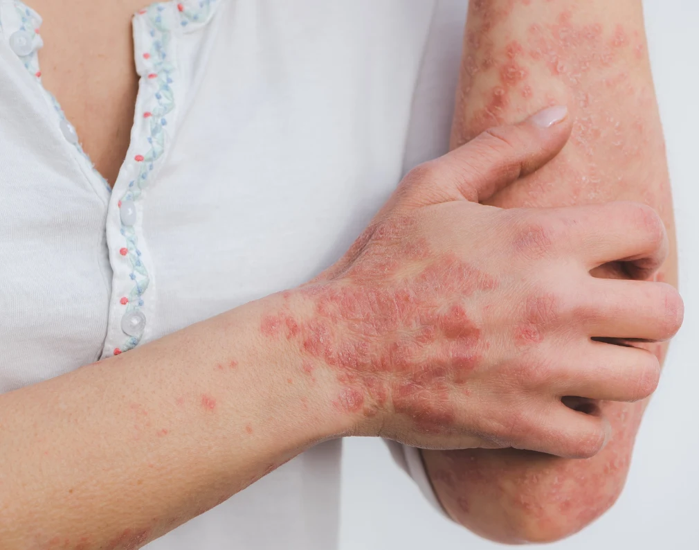 skin concern- Eczema & Psoriasis
