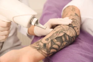 Laser tattoo removal treatment on a forearm tattoo using advanced laser technology at You Glow Aesthetics.