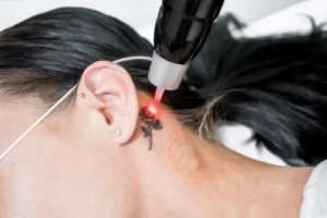 Laser tattoo removal session targeting a small neck tattoo at You Glow Aesthetics.