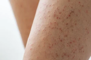 Close-up of strawberry legs with visible dark pores, redness, and irritated hair follicles before laser hair removal treatment.